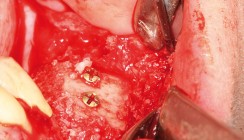 Allogene Knochenblockaugmentation mit einer natürlichen Stammzellressource