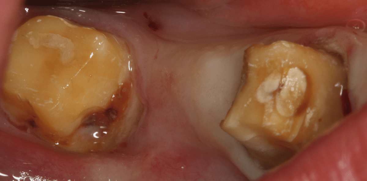 Parodontalchirurgische Therapie intraossärer Knochendefekte