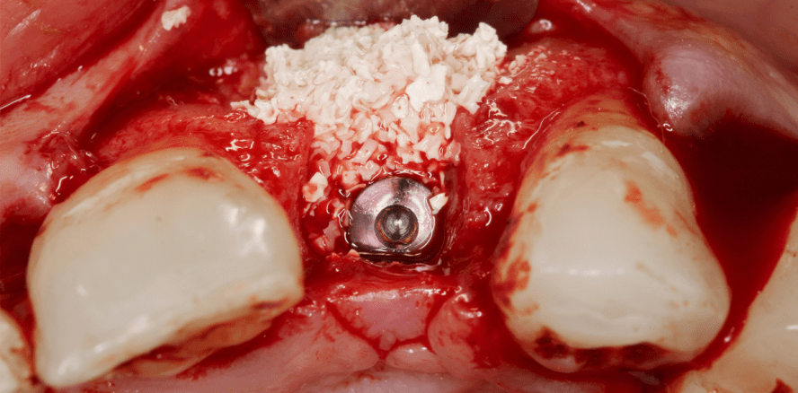 In Kärnten wird an synthetischem Knochenersatz getüftelt