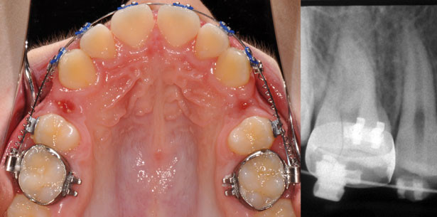 Knochenersatzmaterial aus KFO-Sicht