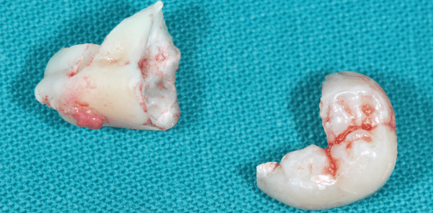 Vermeidung von Knochentaschen bei Weisheitszahn-Osteotomien