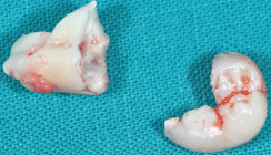 Vermeidung von Knochentaschen bei Weisheitszahn-Osteotomien