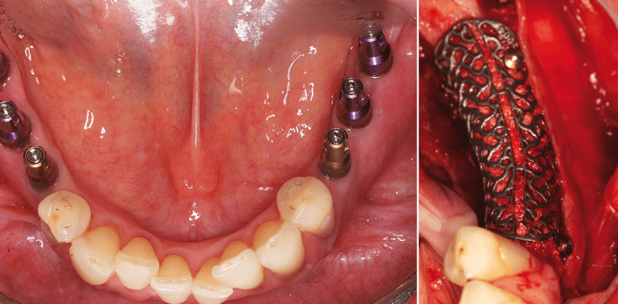 CBR mit individualisiertem CAD/CAM-Titangitter