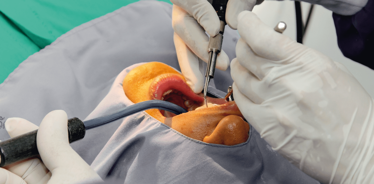 Oralchirurgische Eingriffe bei Patienten unter Antikoagulantientherapie