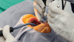Oralchirurgische Eingriffe bei Patienten unter Antikoagulantientherapie