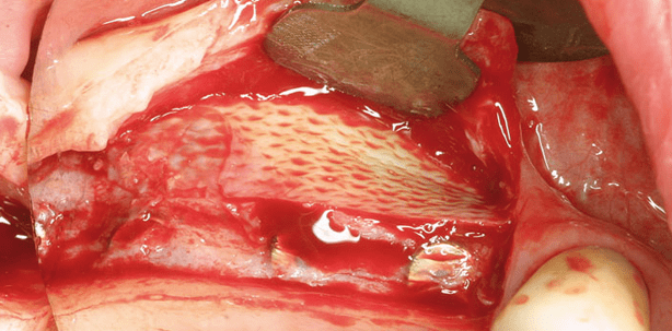 Sinuslift mit Ribose-kreuzvernetzter Kollagenmembran