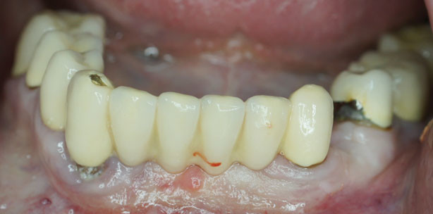 Kollagenmatrix als Ersatz für das autologe Bindegewebs­transplantat