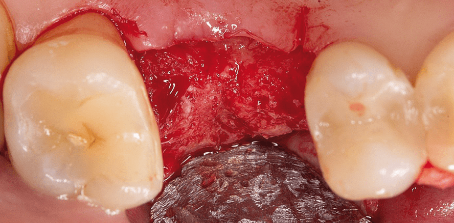 Klinische Erfahrungen mit resorbierbaren Kollagenmembranen