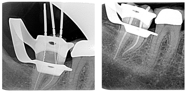2-Feilen-System: Schnelles und effizientes Arbeiten