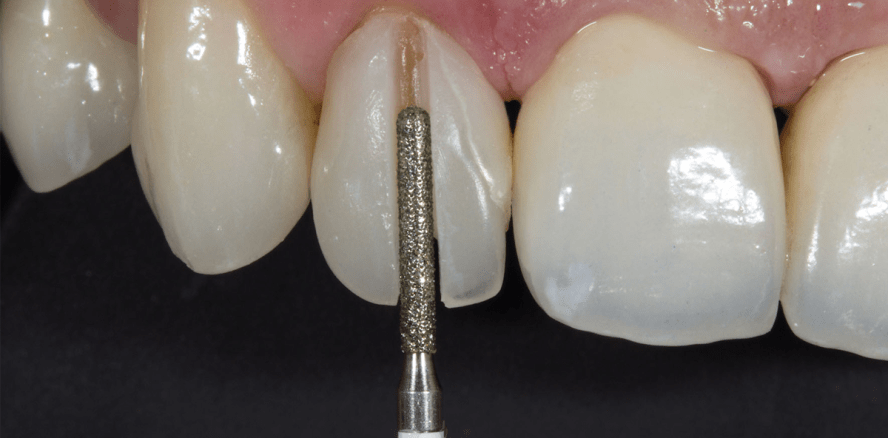 Komplikationen bei vollkeramischen Restaurationen