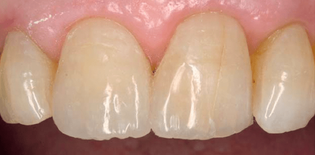 Komposite je nach Indikation wählen