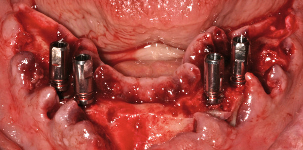 Konusretention von Prothesen auf Implantaten