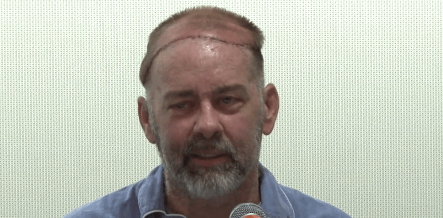 Erstmals Schädeldecke und Kopfhaut erfolgreich transplantiert