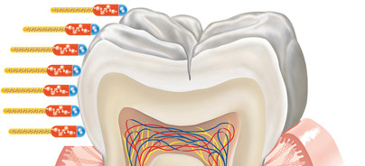 Moderne Wirkstoffe zur Kariesprophylaxe