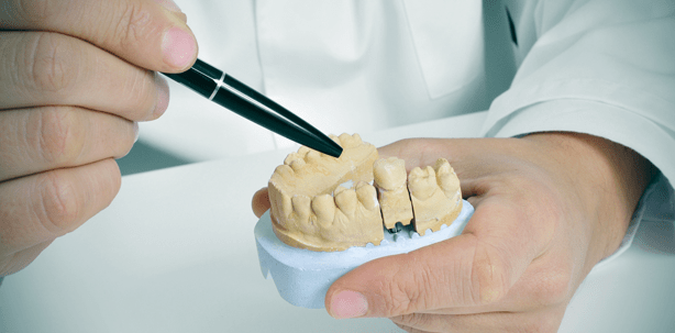 Krone, Brücke, Implantat? Passgenauer Ersatz für den fehlenden Zahn
