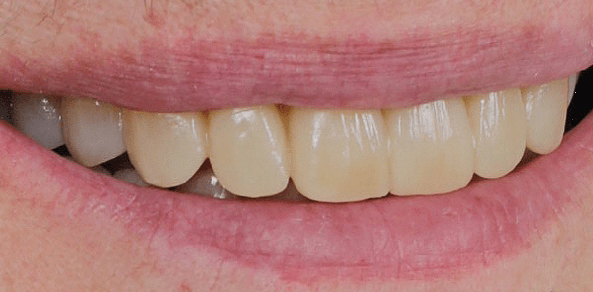 Digitales Smile Design nach Coachman