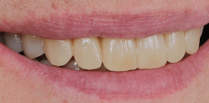 Digitales Smile Design nach Coachman