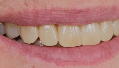 Digitales Smile Design nach Coachman