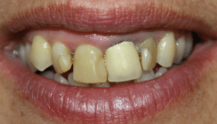 Doping für die Zähne? Die medizinische Notwendigkeit von Veneers