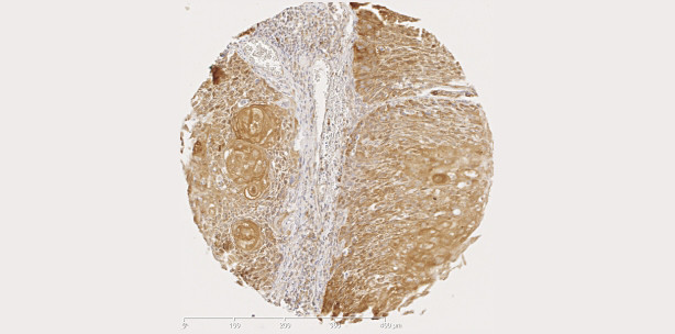 Marker für Verlauf von Krebs im Mund- und Rachenraum gefunden