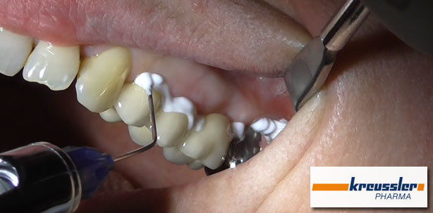 Lokalanästhesie – appliziert, nicht gespritzt!