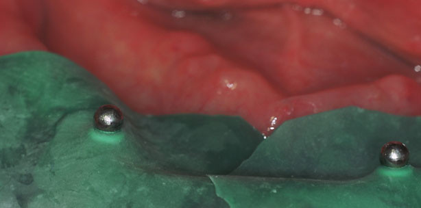 Schnell und schonend zu festem Zahnersatz