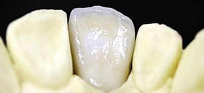 Die Zukunft der Verblendtechnik