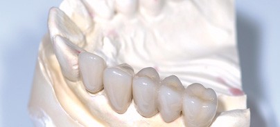 Anwendung eines dualhärtenden Befestigungskomposits