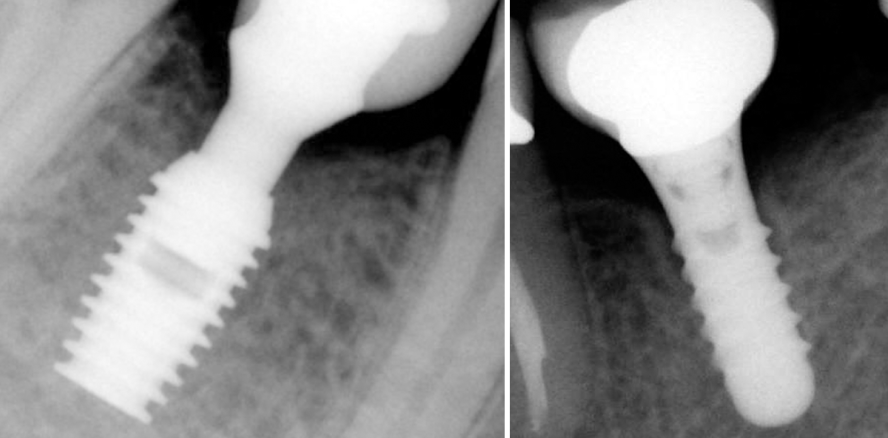 Kieferknochenerhalt beim Einsatz von Kurzimplantaten