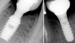 Kieferknochenerhalt beim Einsatz von Kurzimplantaten