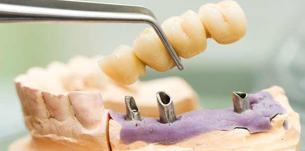 Bestnoten für Brücken, Implantate und Prothesen