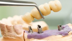 Bestnoten für Brücken, Implantate und Prothesen