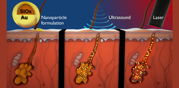 Mit Laser und Gold gegen Akne