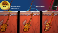 Mit Laser und Gold gegen Akne