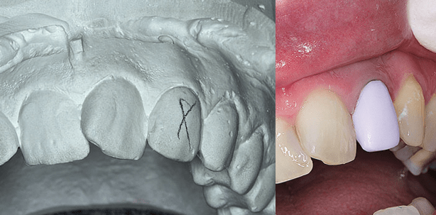 CAD/CAM-Technologie: Lasereinsatz als therapieentscheidender Faktor