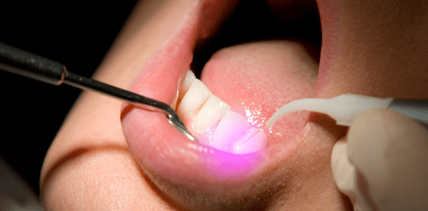 Laser regt Dentin zum Wachsen an