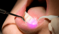 Laser regt Dentin zum Wachsen an