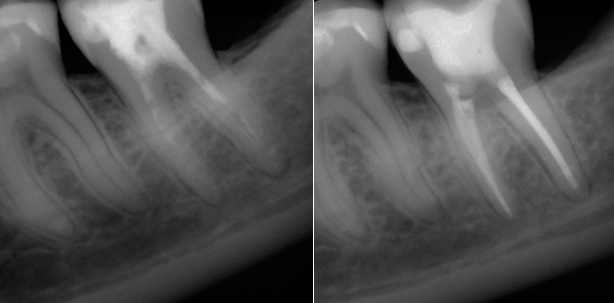 Laser als Erfolgsfaktor der endodontischen Therapie?