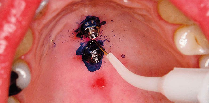 Laser in der KFO-Praxis – Klinik und Labor (1)