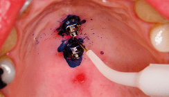 Laser in der KFO-Praxis – Klinik und Labor (1)