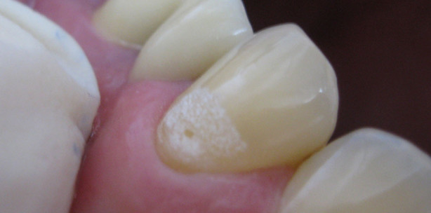 Konventionelle und Laser-Füllungstherapie in der Praxis