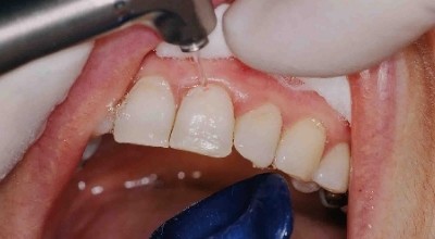 Füllungen im Zahnhalsbereich – mit dem Laser von Vorteil