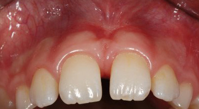 Der Diodenlaser im täglichen Praxiseinsatz