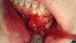 Die Er:YAG-Laserosteotomie – eine Alternative?