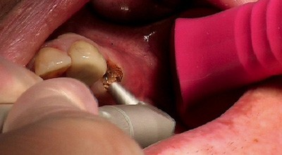 Der Laser in der Implantologie – Wellenlängen und Indikationen