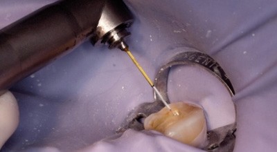 Die laserunterstützte Zahnmedizin in der Praxisroutine