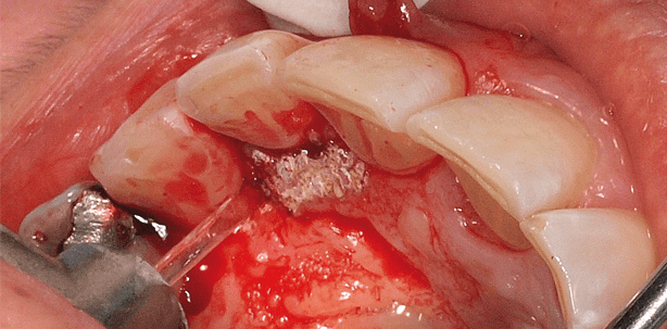 Die laserunterstützte Zahnmedizin in der täglichen Praxisroutine