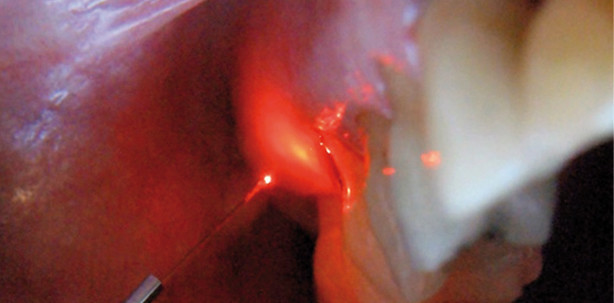 Einsatz eines 970-nm-Lasers zur Parodontitistherapie von Zahn 16