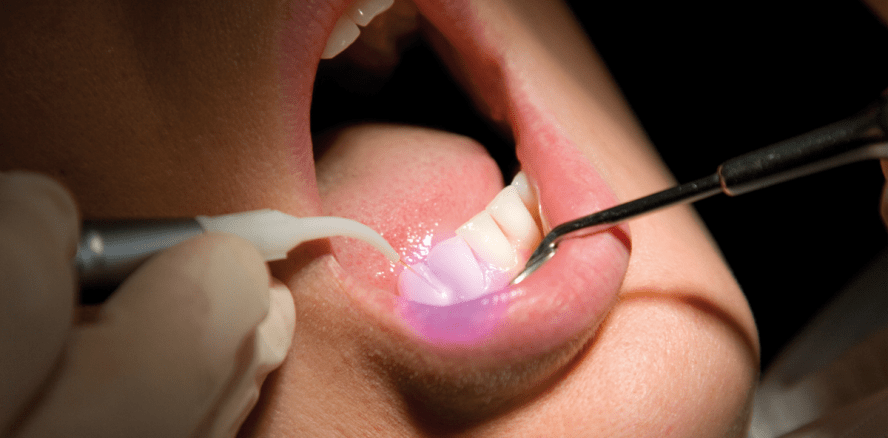 Bewahrt eine neue Lasertherapie Zähne zukünftig vor dem Ausfallen?