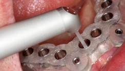 Knochenwachstumsfaktoren PDGF: Stimulierung mit Erbiumlaser